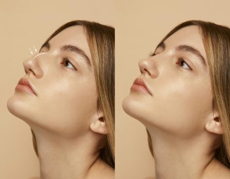 woman-getting-ready-nose-job-surgery
